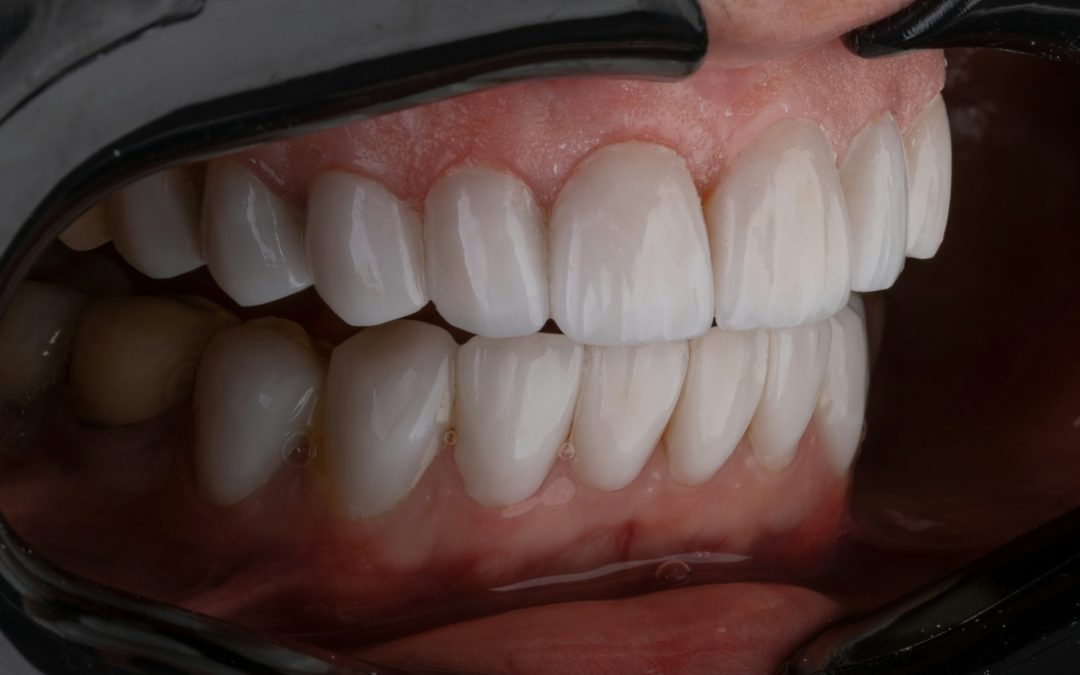 Fogászati műhiba esetbemutatás – implantátum és korona elveszítése a front régióban